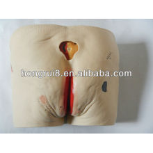 HOTSALES Advanced decubitus ulcers Care bedsores pressure ulcers model